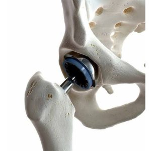Hip Replacement Recovery: Q&A with a Hip Specialist
